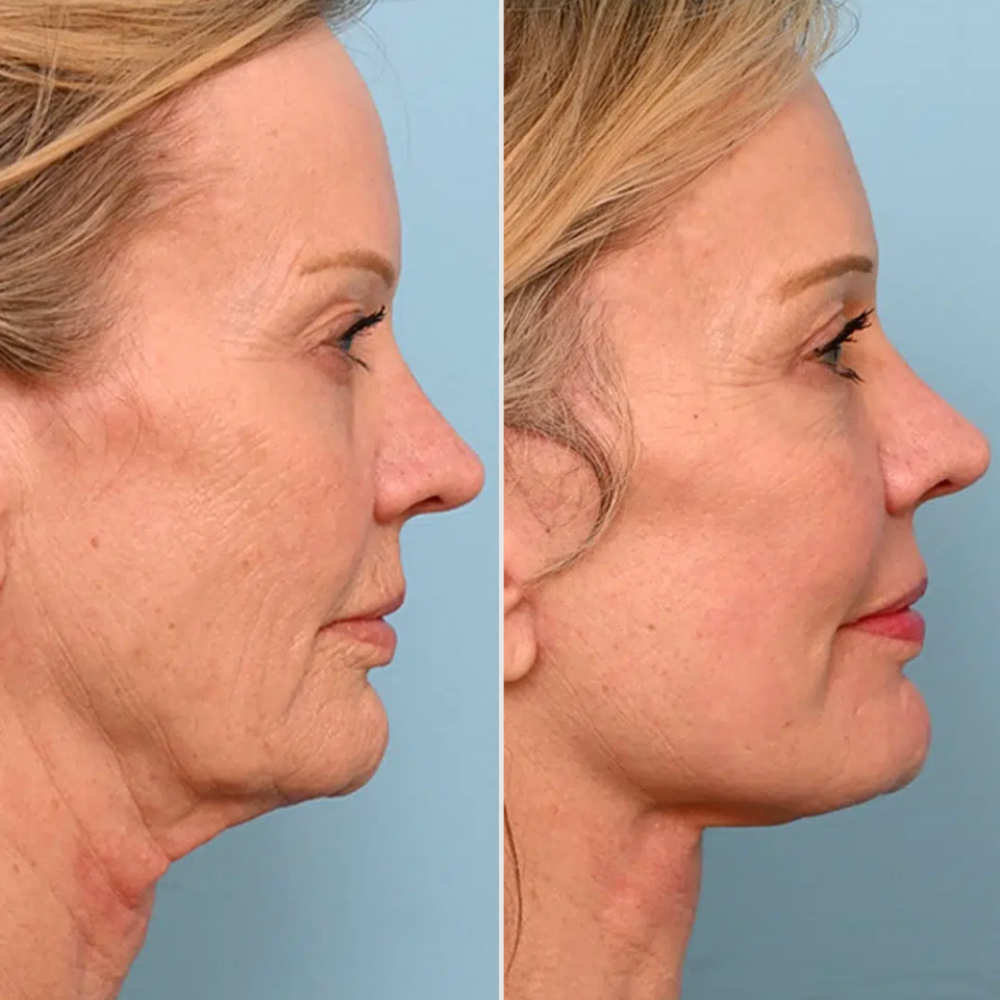 Liftet Kiefer & Hals sichtbar in nur 6–8 Wochen